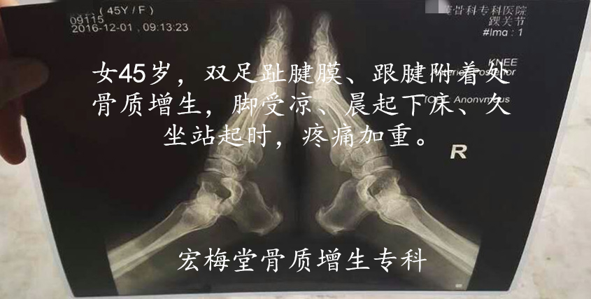 骨质增生的症状是什么,骨质增生怎么治疗