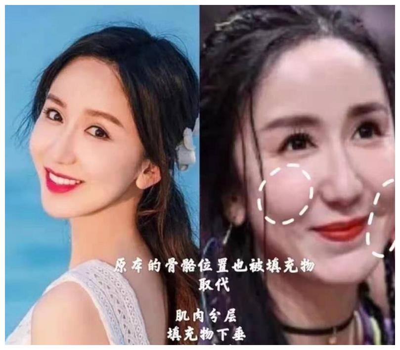 王子文美商太高填充成功回到18岁为啥娄艺潇变发面馒头