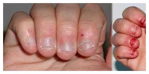 11岁男孩因为"啃手指",啃出"大问题",家长不要再忽视了!