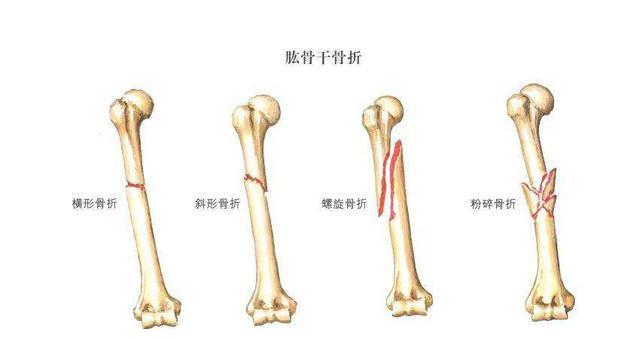 万茜右臂肱骨骨折,具体部位在哪?大概什么时候能重返《浪姐》?