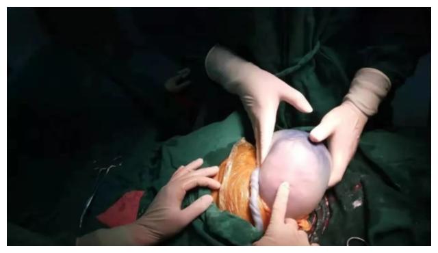 新生儿刚出生被透明膜包裹妈妈怎么生出个肉球医生是胎膜