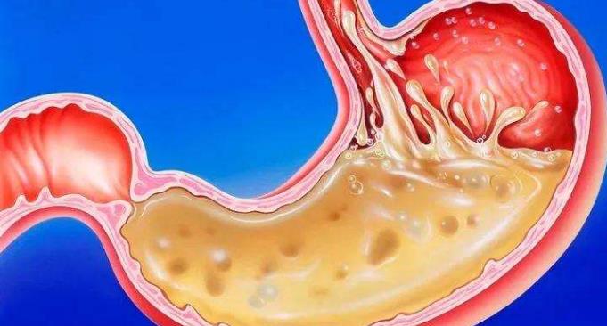 胃酸反流是咋回事？4类人易出现胃酸反流，请多加留心！休闲区蓝鸢梦想 - Www.slyday.coM