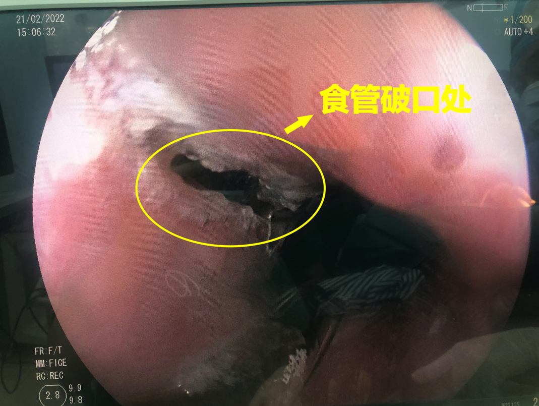 八旬老人晕车呕吐食管破裂珠海市中西医结合医院及时救命