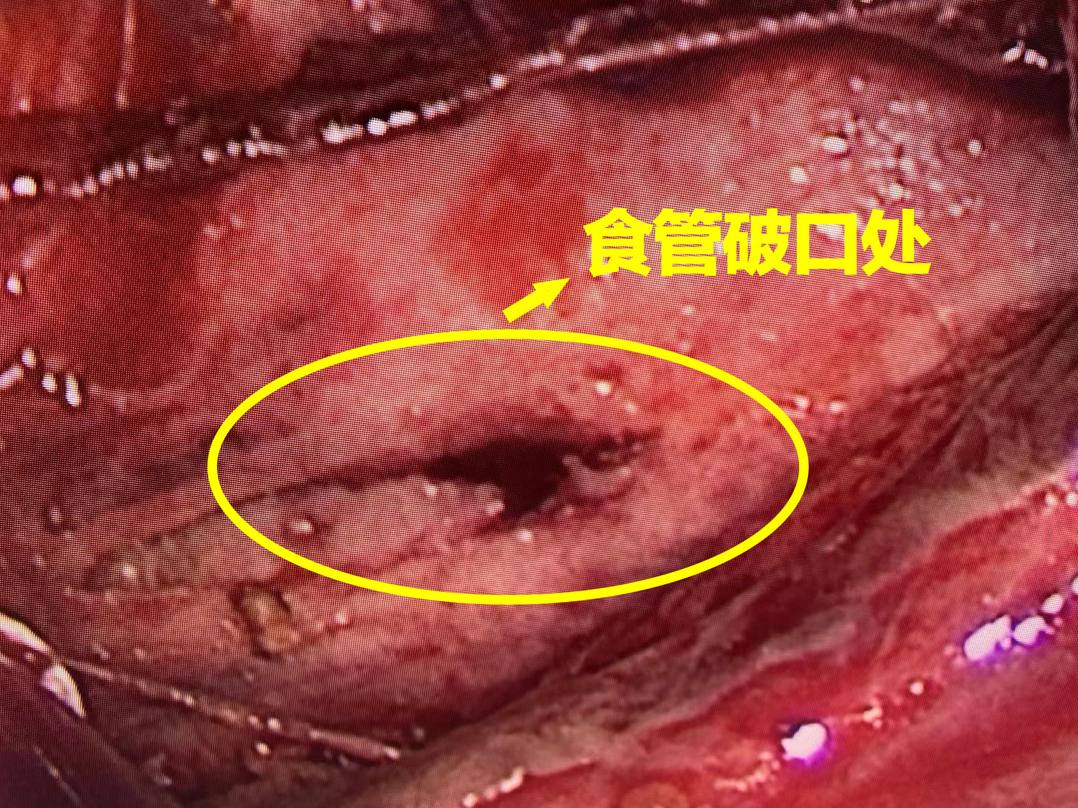 八旬老人晕车呕吐食管破裂珠海市中西医结合医院及时救命