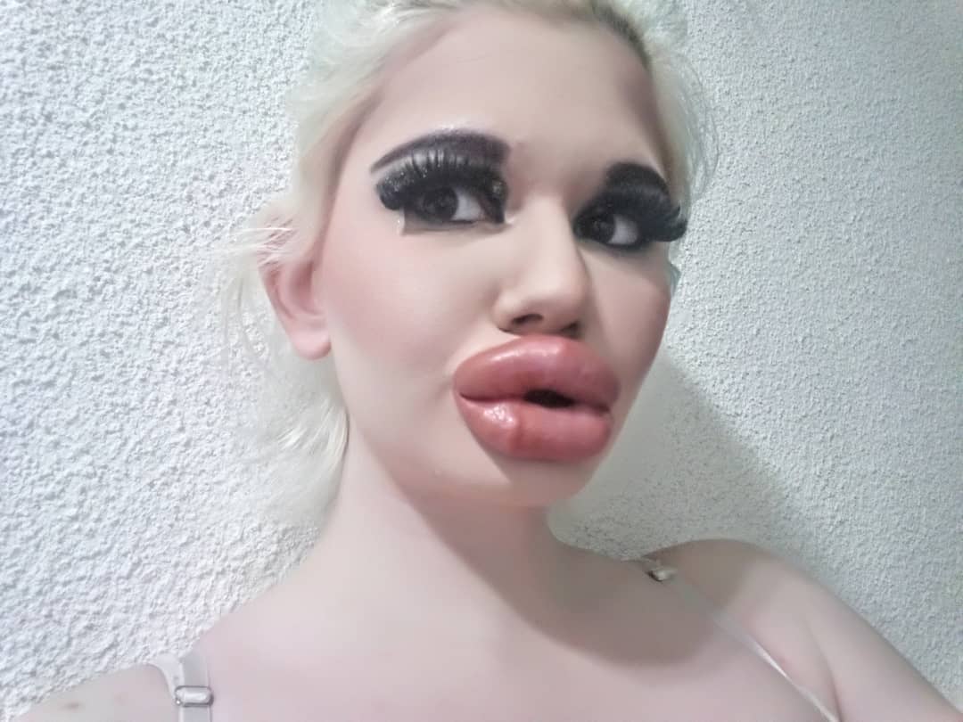 她做20次丰唇手术,只为让自己嘴唇更性感,想成世界