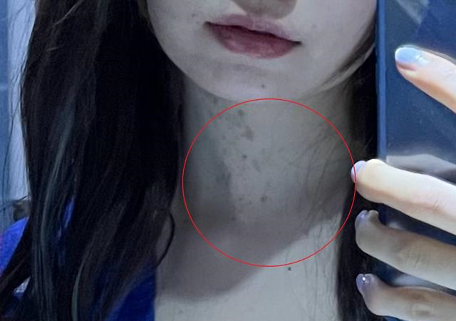 陈卓璇脖子里的一块块斑是什么 陈卓璇脖子上长疙瘩黑点是怎么回事