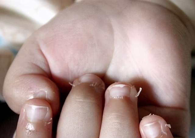 孩子手上出现倒刺难道是孩子缺钙的表现这些原因需要家长知道
