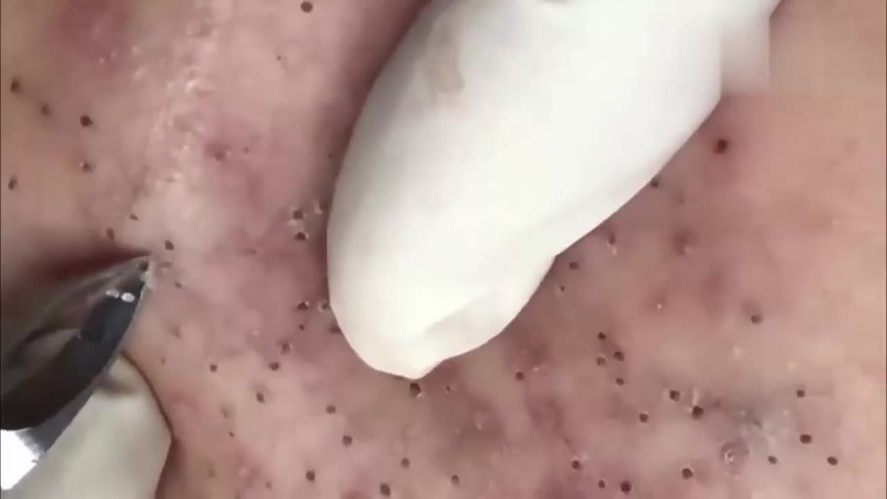 脸上全是米粒大小的痘痘,医生一颗一颗的拔出来