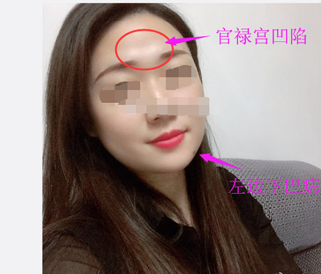 女士的官禄宫(额头正中)明显凹陷,早运会有较多不顺,做事容易犯错