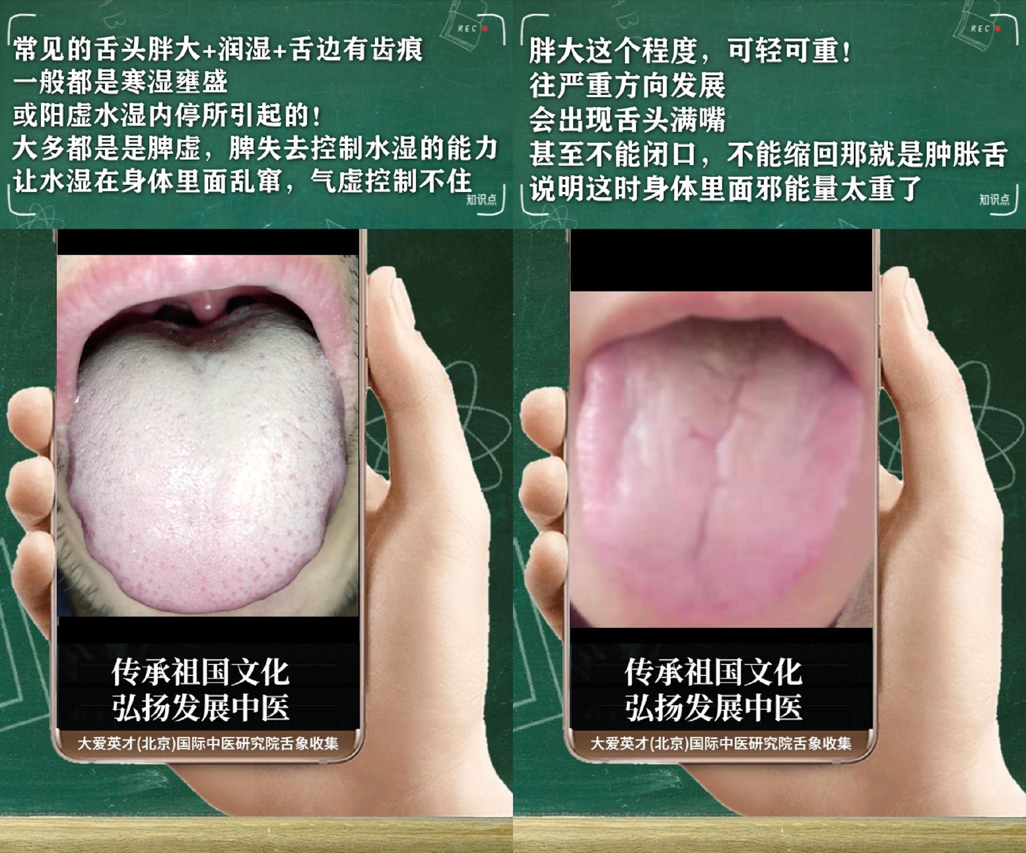 舌诊医案:常难过、易怒心烦、经常咳嗽、反复不断很受困扰休闲区蓝鸢梦想 - Www.slyday.coM 舌诊医案:常难过、易怒心烦、经常咳嗽、反复不断很受困扰休闲区蓝鸢梦想 - Www.slyday.coM