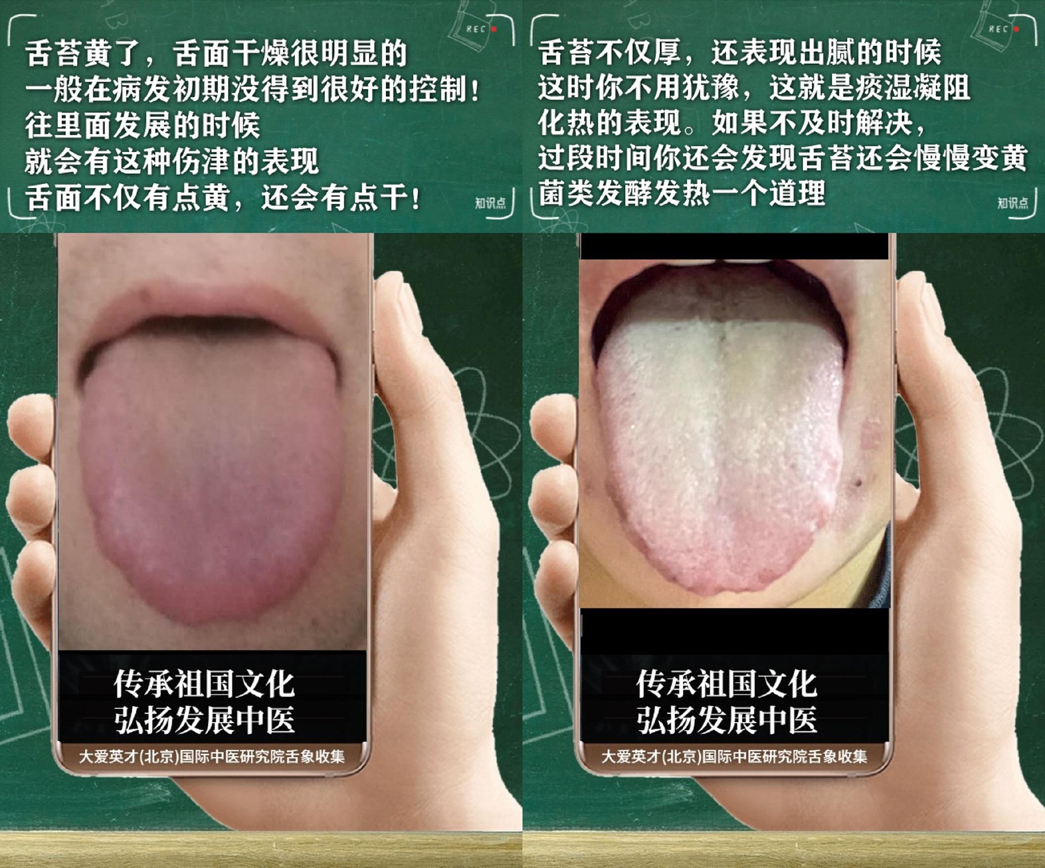 舌诊医案:常难过、易怒心烦、经常咳嗽、反复不断很受困扰休闲区蓝鸢梦想 - Www.slyday.coM 舌诊医案:常难过、易怒心烦、经常咳嗽、反复不断很受困扰休闲区蓝鸢梦想 - Www.slyday.coM