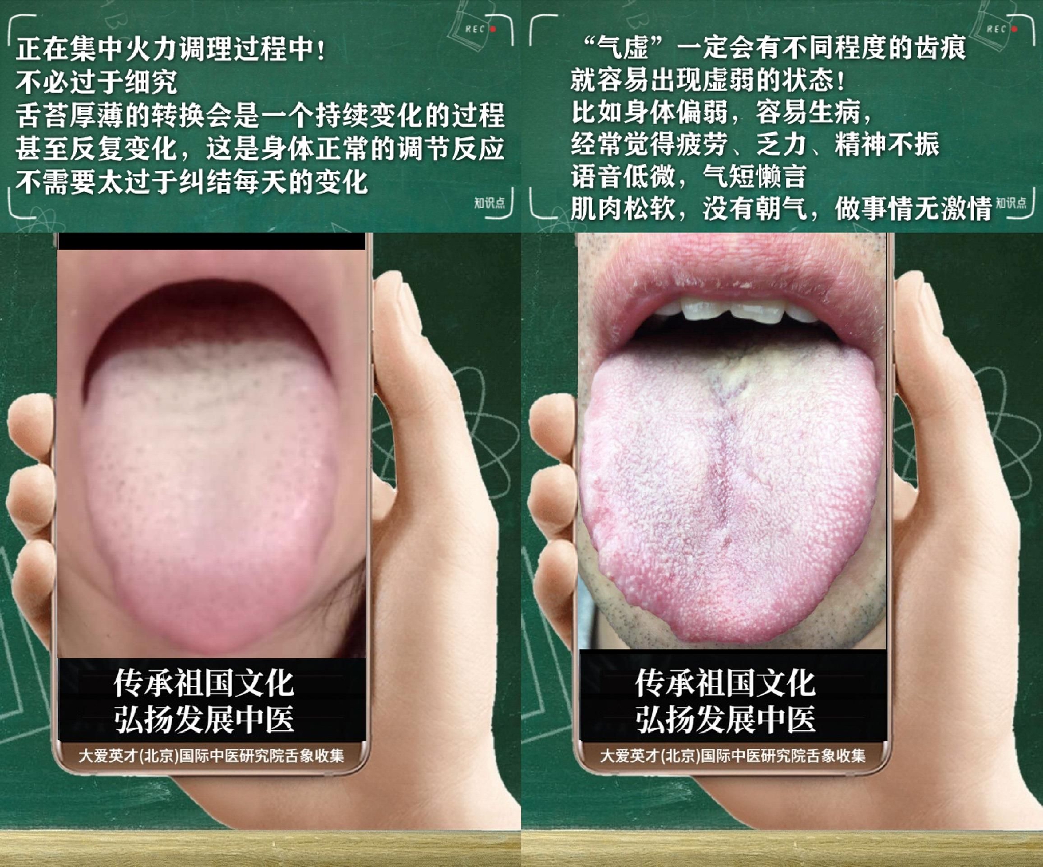 舌诊医案:常难过、易怒心烦、经常咳嗽、反复不断很受困扰休闲区蓝鸢梦想 - Www.slyday.coM 舌诊医案:常难过、易怒心烦、经常咳嗽、反复不断很受困扰休闲区蓝鸢梦想 - Www.slyday.coM