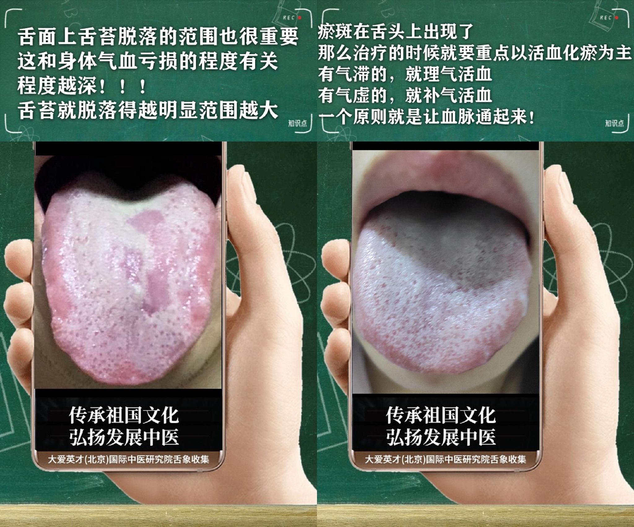 舌诊医案:常难过、易怒心烦、经常咳嗽、反复不断很受困扰休闲区蓝鸢梦想 - Www.slyday.coM 舌诊医案:常难过、易怒心烦、经常咳嗽、反复不断很受困扰休闲区蓝鸢梦想 - Www.slyday.coM