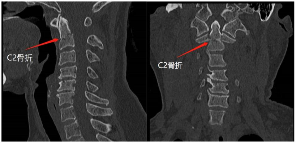 3d建模重建以及模拟手术的方法,为梁婆婆进行了颈椎齿状突骨折手术
