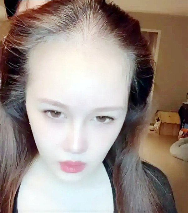 赵本山女儿无美颜近照吓坏网友面色苍白脱发严重酷似裘千尺