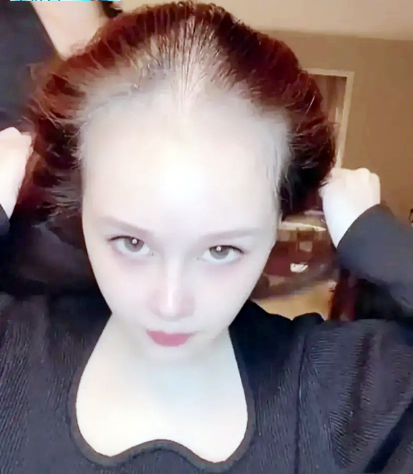 赵本山女儿无美颜近照吓坏网友面色苍白脱发严重酷似裘千尺