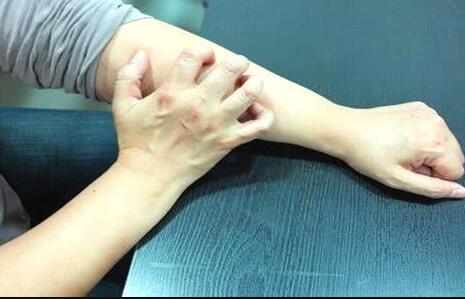 体内血糖升高，皮肤会出现3种异常，可能是糖尿病找上门了！