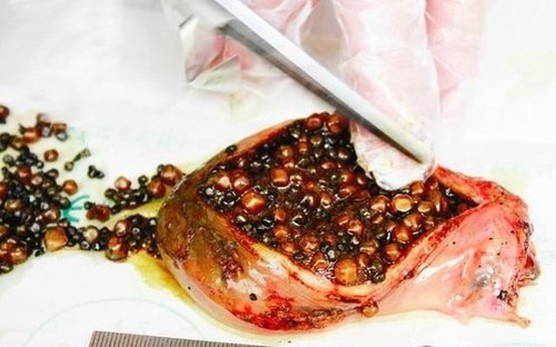 四川男子生吃鱼胆想养肝明目致中毒需透析10多次保命