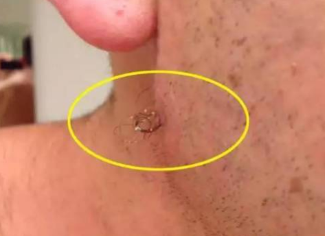 小伙在脸上挤痘痘拔出一根几十厘米毛发比头发还长