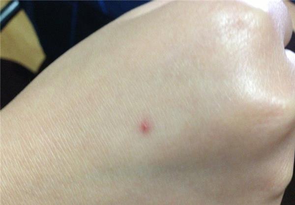 为什么有的人被蚊子咬后起一个大包,有的人则是出现一个红点?