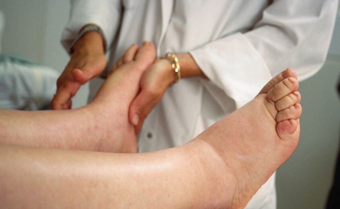 尿毒症出现身体通常有哪些症状图