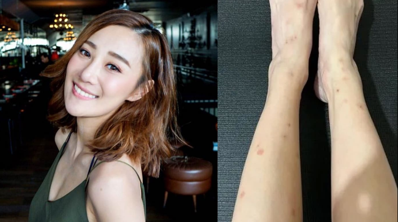 被床虱狂咬1个月朱智贤因创伤后遗症噩梦连连