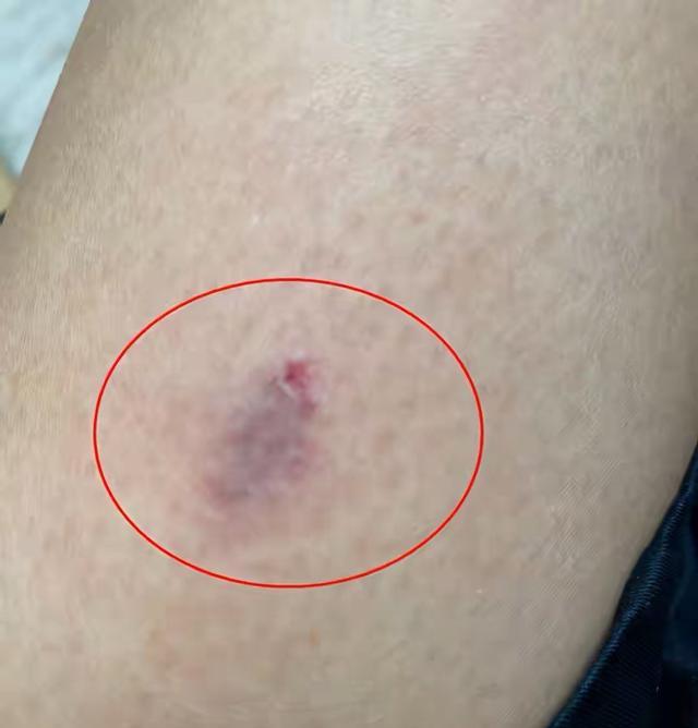 蔡少芬录制节目被狗咬了伤口严重不堪入目深夜紧急前往医院