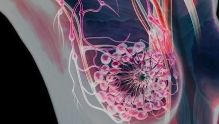 良性乳腺疾病概述-脂肪瘤