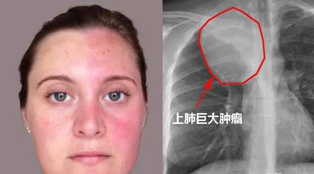 肺癌可能出现在外表的一些症状有些一看就知道肺出了问题