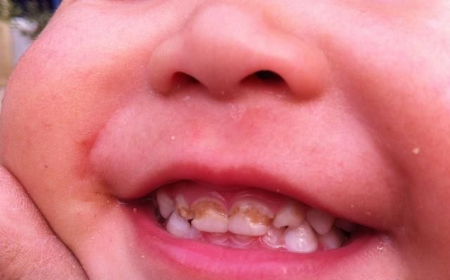 孩子嘴里有"双排牙"?主要原因有两个,多半是父母的缘故!