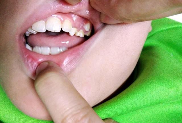 乳牙|牙齿|恒牙_新浪新闻