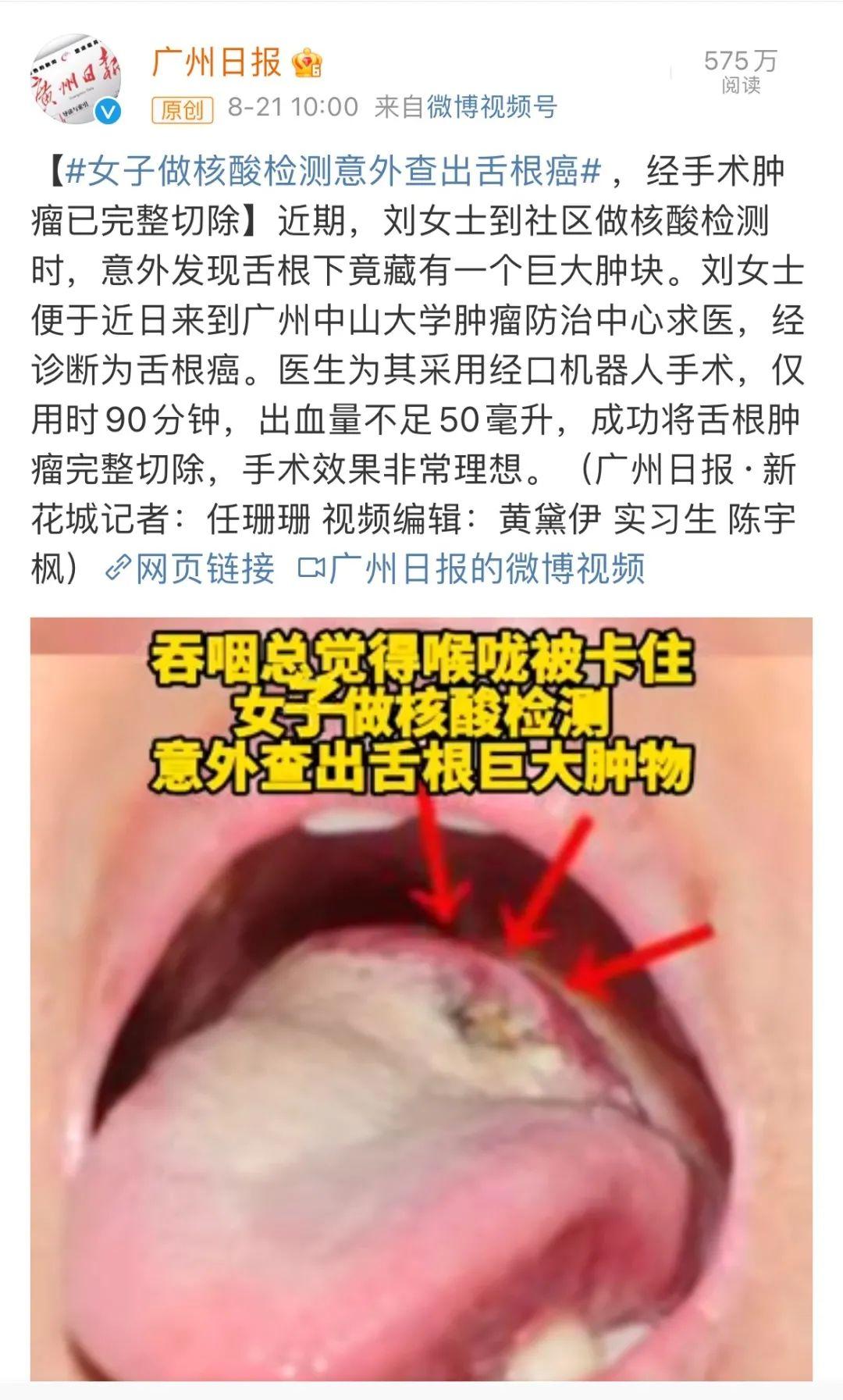 舌头乳头状瘤,良性舌根乳头状瘤图片 - 伤感说说吧