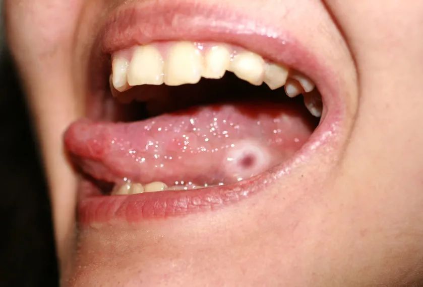 口腔癌舌头图片