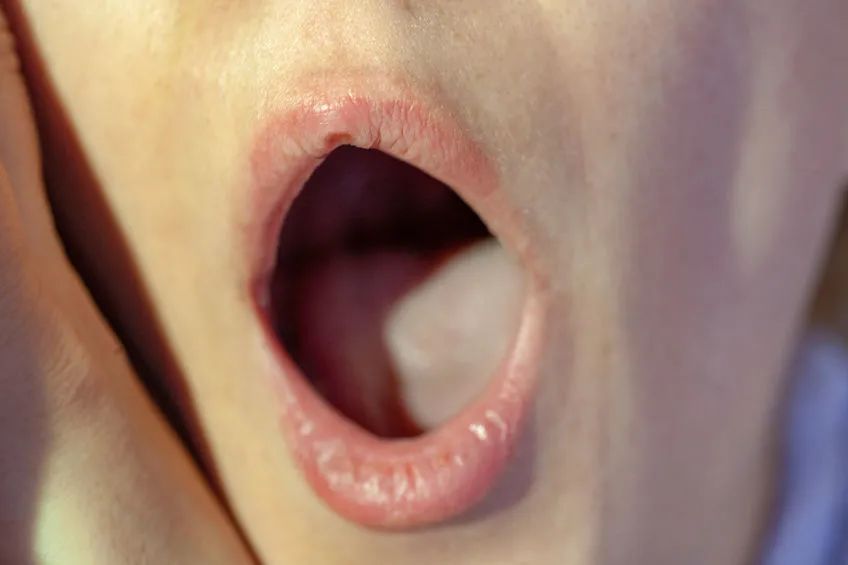 女子做核酸检测意外发现舌部肿块医生这癌恶性程度高生长快