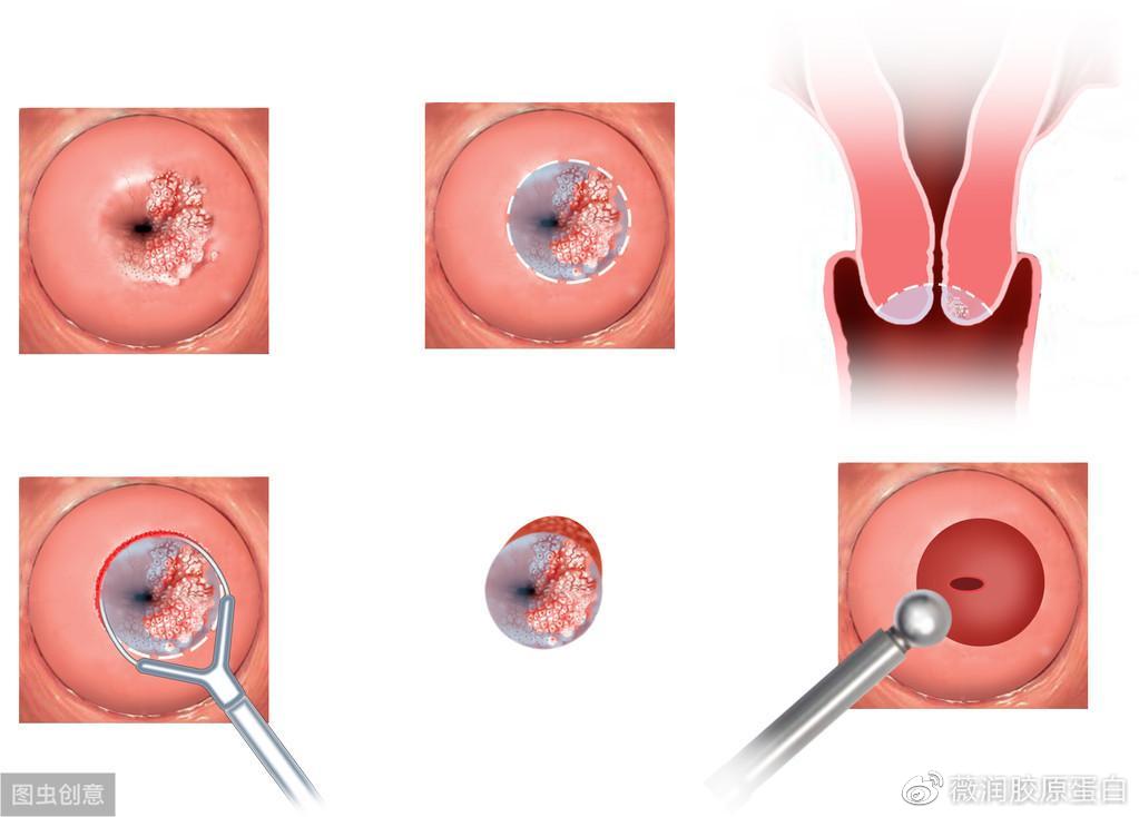hpv感染到宫颈癌,距离有多远,这篇文章告诉你!