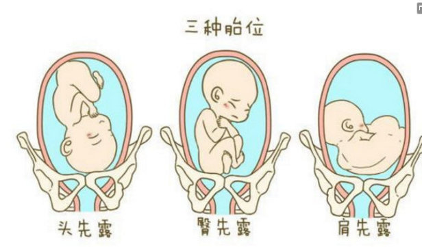 这四种孕妇选择顺产的话,不仅疼,而且还很危险,特别是第四种|顺产|孕妇|胎儿_新浪新闻