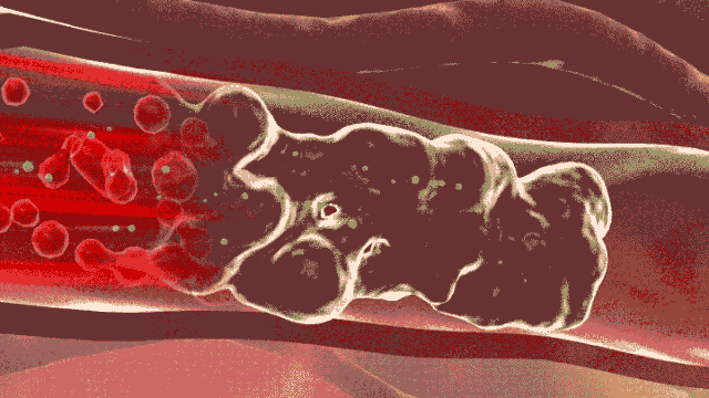 渭南市第二医院心血管内科：8张动图揭秘血管被堵的全过程休闲区蓝鸢梦想 - Www.slyday.coM