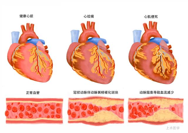 渭南市第二医院心血管内科：8张动图揭秘血管被堵的全过程休闲区蓝鸢梦想 - Www.slyday.coM