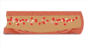 渭南市第二医院心血管内科：8张动图揭秘血管被堵的全过程休闲区蓝鸢梦想 - Www.slyday.coM