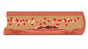 渭南市第二医院心血管内科：8张动图揭秘血管被堵的全过程休闲区蓝鸢梦想 - Www.slyday.coM