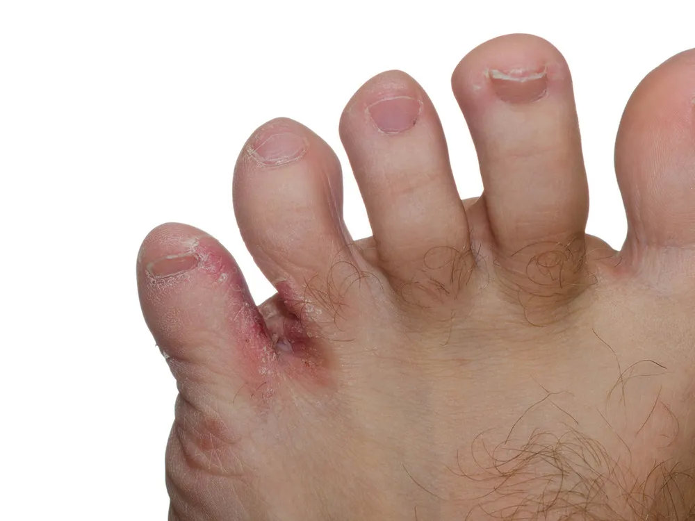 是不是脚气,还得看症状