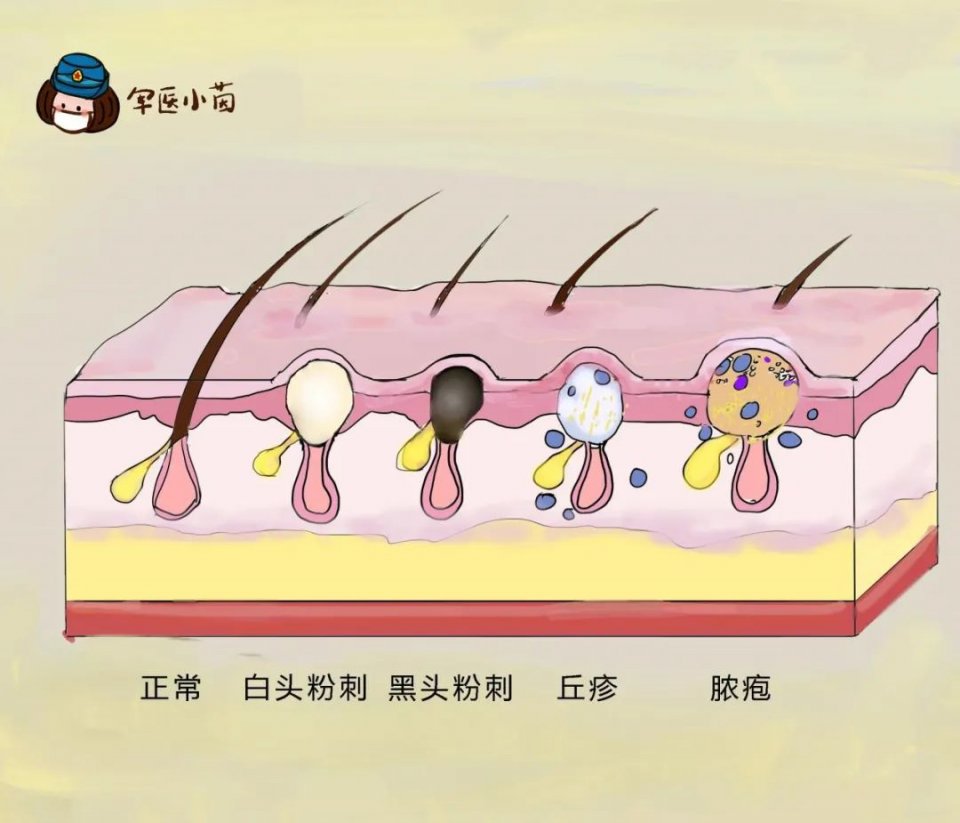 皮脂膜受损症状反应 如何修复受损皮脂膜