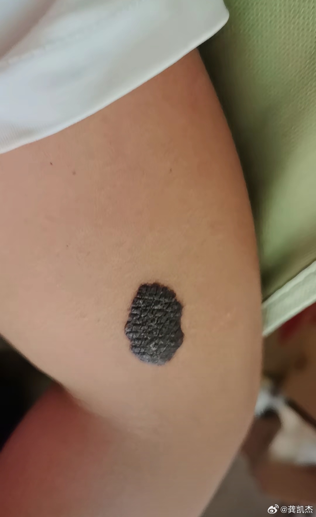 这种色素痣大多数都是良性的,现在医学发达了,可以尽早处理的!