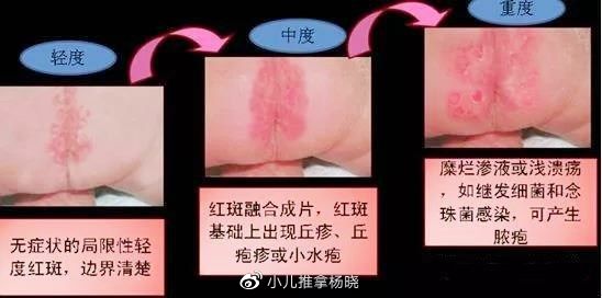 尿布疹的预防与护理方法?|尿布疹|屁股|杨晓_新浪新闻