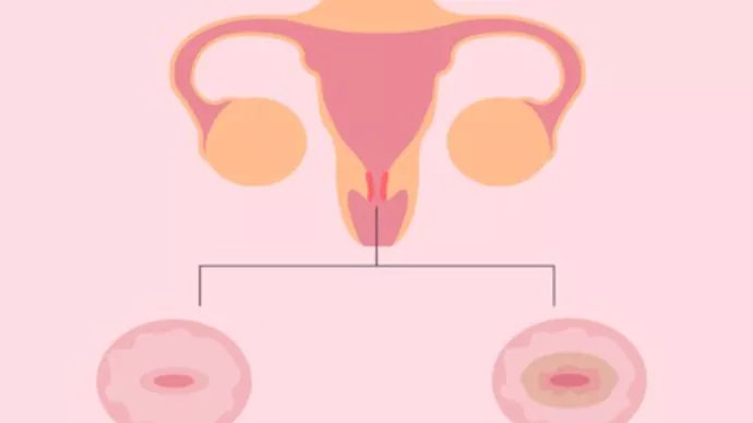 新技术 | 宫颈高危hpv感染?别怕!光动力治疗为女性解忧