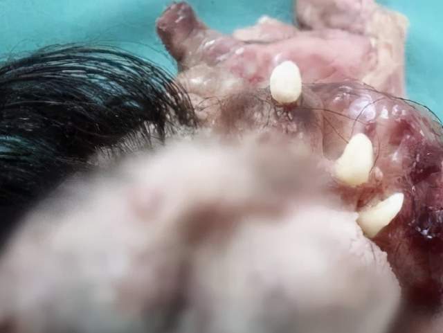 瘤界"百变大咖"——畸胎瘤|上海健康医学院|畸胎瘤|百变_新浪新闻