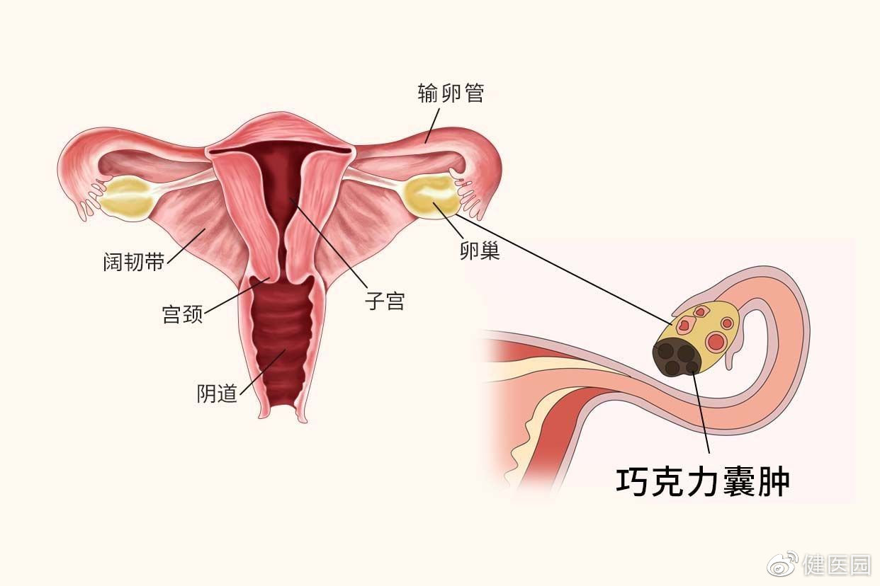 巧克力囊肿的图片图片