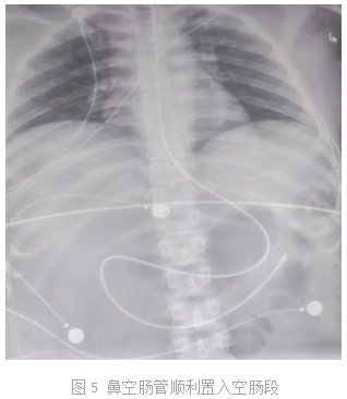 空肠管总是盘曲在口腔这个技巧让你67下管如有神