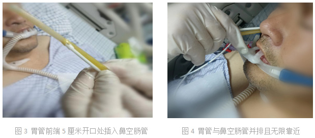 空肠管总是盘曲在口腔这个技巧让你67下管如有神