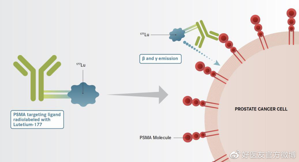 期待晚期前列腺癌患者有望迎来创新靶向放射配体疗法